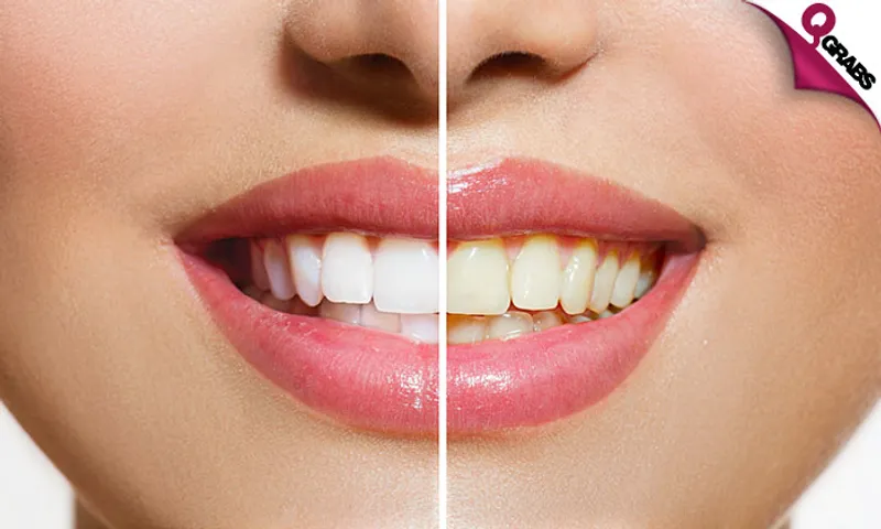 Teeth Whitening + Scaling & Polishing!